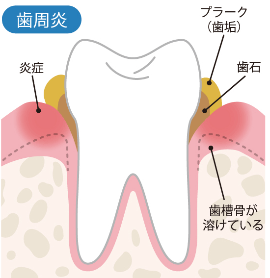 歯周炎
