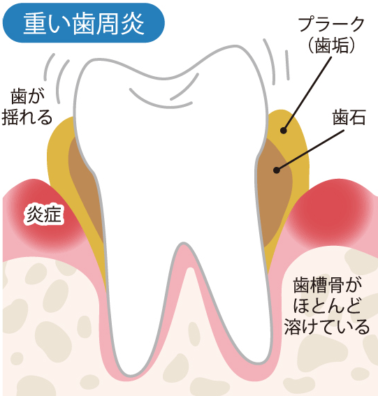 重い歯周炎