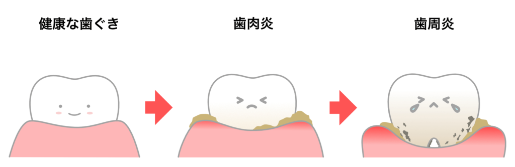 歯肉炎から歯周炎へ